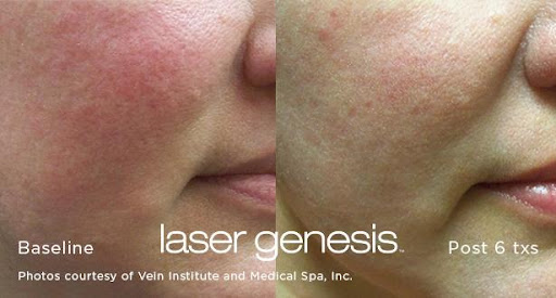 Laser Genesis Treatment Honolulu